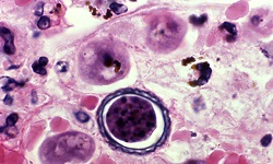 Acanthamoeba